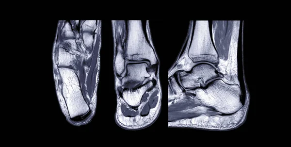 Mri Ankle关节轴位 冠状位和矢状位T2观点对诊断肌腱损伤的比较 — 图库照片
