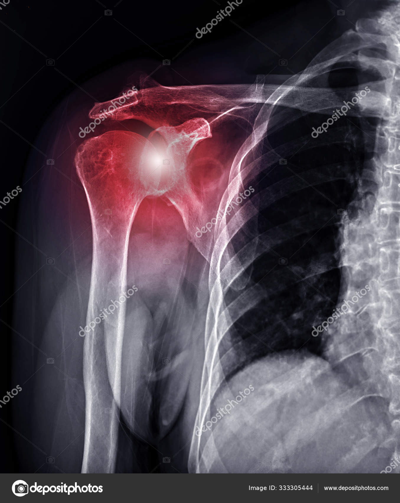 Xray Shoulder joint for diagnosis shoulder joint dislocation. Stock