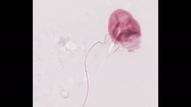 Böbrek naklinden sonra böbreklerin renal arter stenozu anjiyografisi.