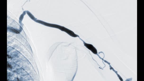 Léggömb Angioplasztika Brachiális Artéria Karban Mielőtt Léggömb Kitágult Képernyőn Intervenciós — Stock videók