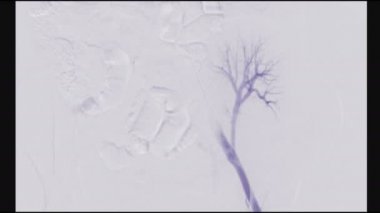 Böbrek naklinden sonra böbreklerin renal arter stenozu anjiyografisi.