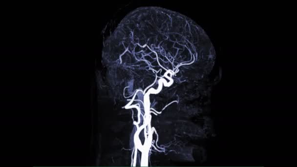 Cta Brain Або Комп Ютерна Томографія Cerebral Загальні Каротидні Артерії — стокове відео