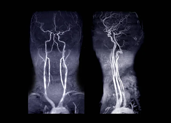 Mra Gehirn Und Hals Oder Magnetresonanzangiographie Mra Der Zerebralen Arterie — Stockfoto