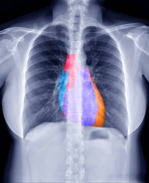 Fusion Image Chest Ray Image Cta Coronary Artery Image Showing — Stock Photo, Image