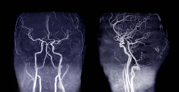 Arm Angiographie Cérébrale Par Résonance Magnétique Arm Artère Cérébrale Artère — Photo