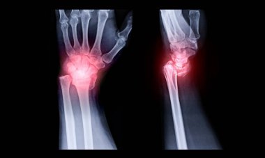 X-ray image of Left wrist joint AP and Lateral view  clipart