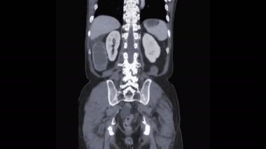  CT whole abdomen with contrast  media coronal view showing bowel obstruction.