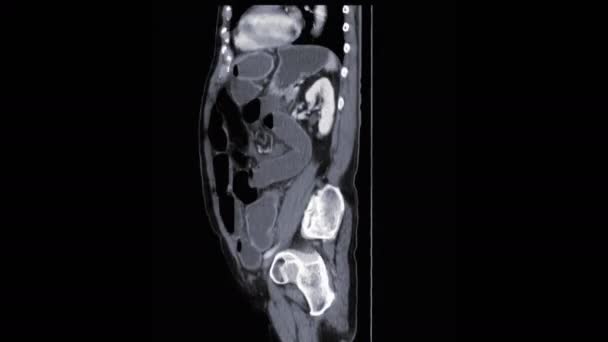  CT abdomen entier avec contraste sagittal montrant une obstruction intestinale .