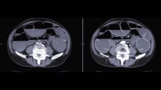 Comparaison de CT abdomen entier sans opacifiants et avec des opacifiants montrant une obstruction intestinale .