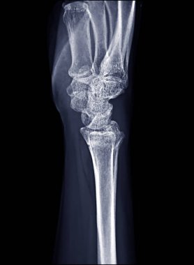 X-ray image of Right wrist joint Ap and Lateral view clipart