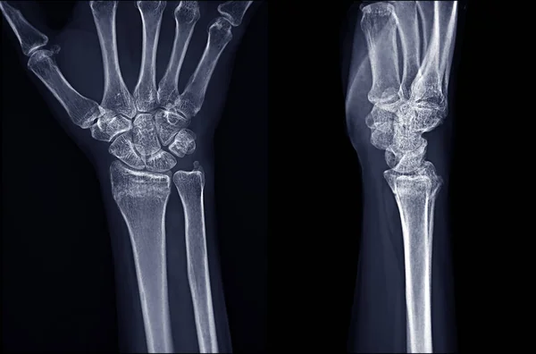 X-ray image of Right wrist joint Ap and Lateral view — Stockfoto