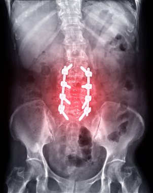 L-S omurga Ap Operatif Lumbar Plakaları ve vida.