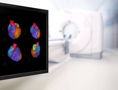 Selective focus of CTA Coronary artery  3D rendering image on the mornitor in CT Scanner room at the hospital. clipart
