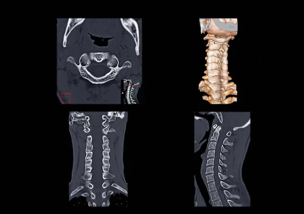 CT C-Spine or Cervical spine axial view , 3D Rendering image , C