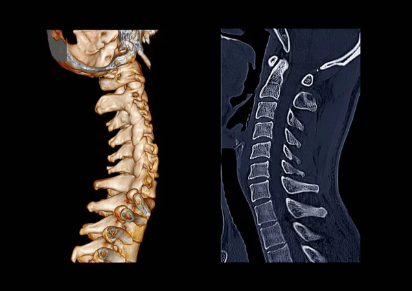 Ct C型脊柱或颈椎3D成像与颈椎成像的比较 — 图库照片