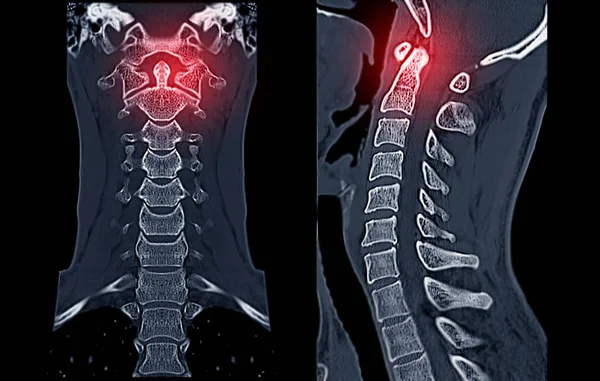 Porównaj Ct C-Spine lub szyjnego kręgosłupa 3d Rendering obrazu i — Zdjęcie stockowe