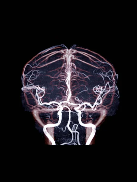 核融合画像Og MraとMrv脳の循環血流を示す脳 — ストック写真
