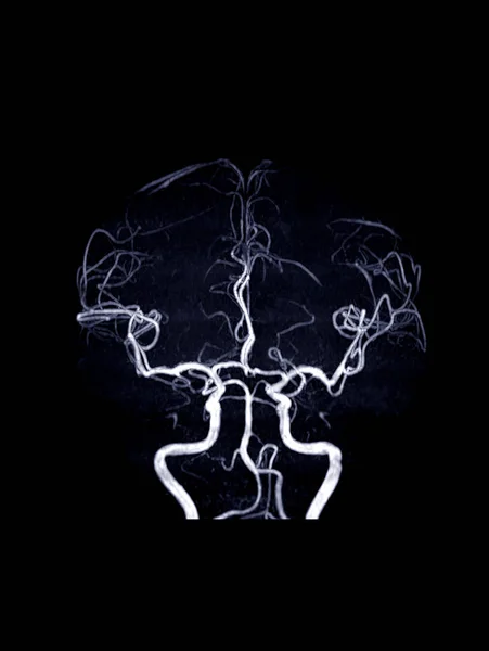 Mrv Venografia Mózgu Lub Rezonansu Magnetycznego Mózgu Dla Nieprawidłowości Drenażu — Zdjęcie stockowe