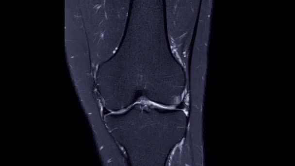 膝关节冠状搅拌观点对脂肪抑制的磁共振成像 — 图库视频影像