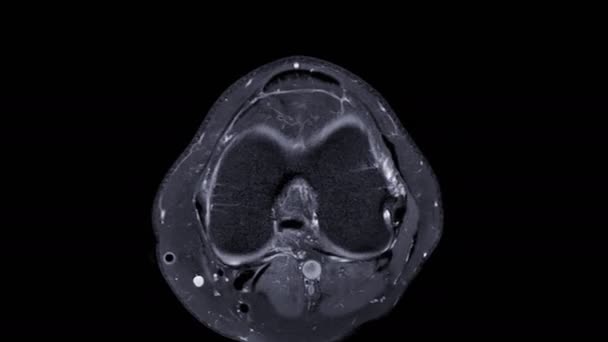 Mri Knie Magnetische Resonantie Beeldvorming Van Knie Gezamenlijke Axiale Roerzicht — Stockvideo