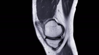 Diz eklem karşılaştırması sagittal Pdw görünümünün MRI veya Manyetik rezonans görüntülemesi.