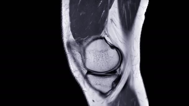 Mri Knie Oder Magnetresonanztomographie Des Kniegelenks Vergleich Sagittal Pdw View — Stockvideo