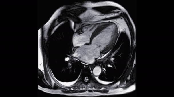 Mri Heart Cardac Mri心臓の磁気共鳴画像4チャンバビュー左房 右房を示す心臓疾患を検出するための — ストック動画