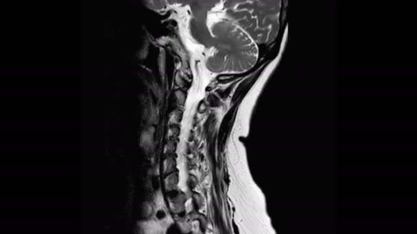 Mri Der Halswirbelsäule Sagittal T2W Ansicht Für Diagnostische Kompression Des — Stockvideo