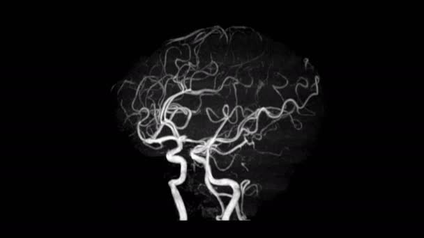 Рентгеновское Рентгеновское Изображение Шейного Отдела Позвоночника Сонной Артерией — стоковое видео