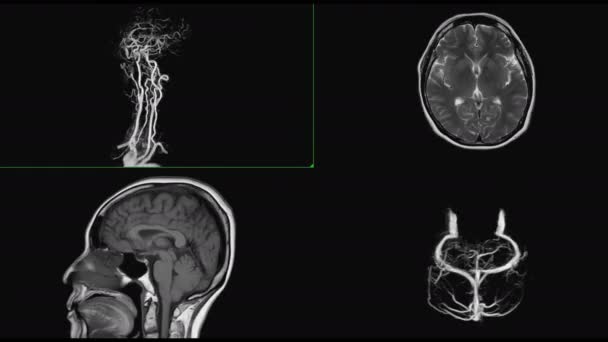 Рентгенівське Зображення Хребта Або Рентгенівське Зображення Шийного Відділу Хребта Каротидною — стокове відео
