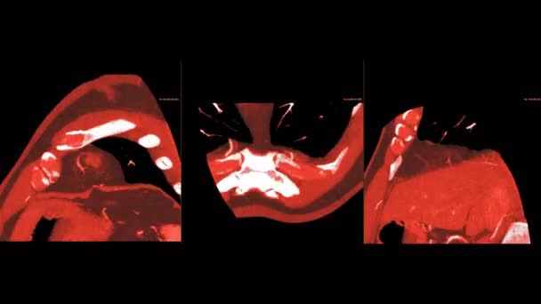 Mri心臓または心臓Mri心臓の磁気共鳴画像3左室ビューのアトリウム 心疾患を検出するための僧帽弁および大動脈弁 — ストック動画