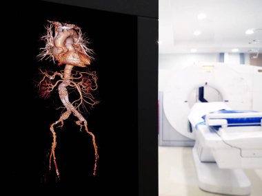 CT tarayıcı odasındaki ekranda şeffaf iskelet üzerinde stent grefti bulunan CTA abdominal aort 3D görüntüleme.