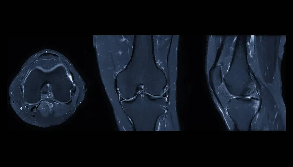 Vergelijking Van Mri Knie Magnetische Resonantie Beeldvorming Van Knie Gezamenlijke — Stockfoto