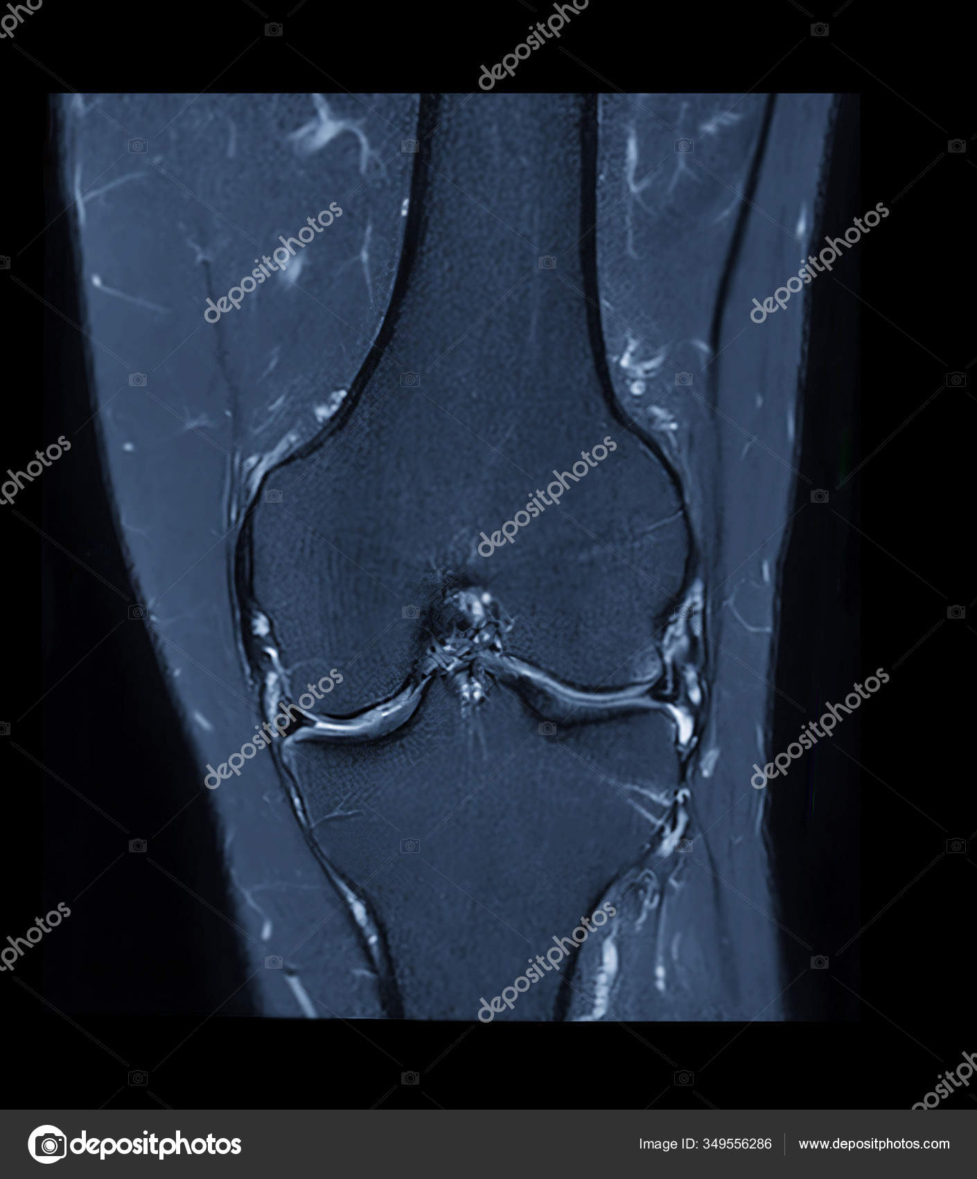 Irm Genou Imagerie Par Résonance Magnétique