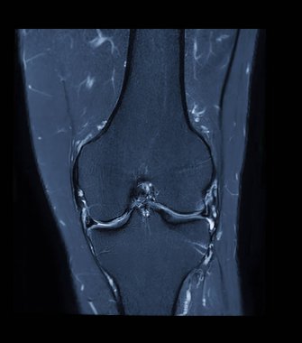 MRI knee or Magnetic resonance imaging of knee joint stir technique of  coronal view for fat suppression. clipart