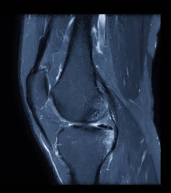 MRI knee or Magnetic resonance imaging of knee joint stir technique of sagittal view for fat suppression. clipart