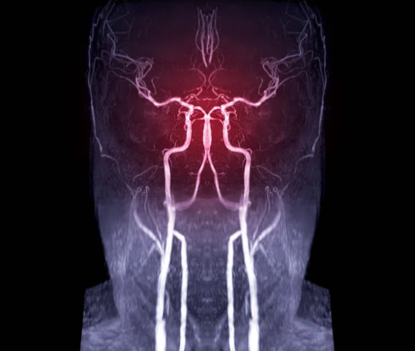 Mra Brain Atau Magnetic Resonance Angiography Mra Dari Arteri Serebral — Stok Foto