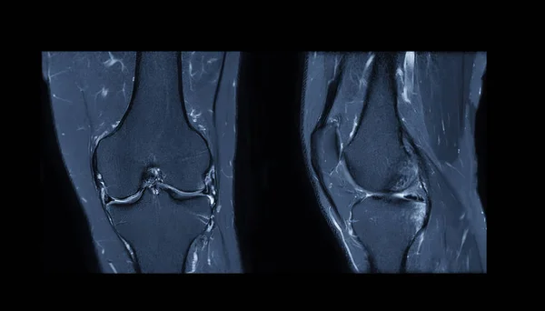 膝関節のMri膝関節の磁気共鳴画像法と脂肪抑制のための皮質とサギッタ ラビューの比較 — ストック写真