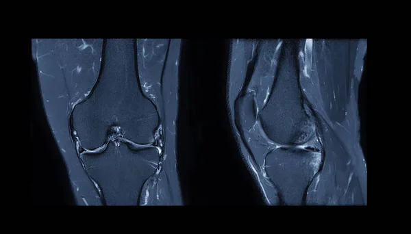 Vergelijking Van Mri Knie Magnetische Resonantie Beeldvorming Van Kniegewricht Roertechniek — Stockfoto