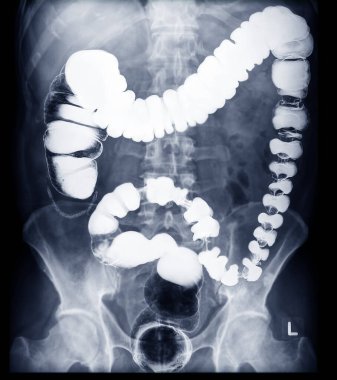 BE or barium enema image or x-ray image of colon prone view showing anatomical of colon for detect Colon cancer .  clipart