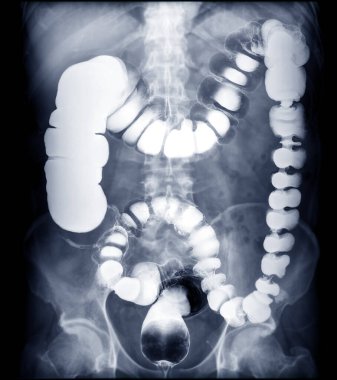 BE or barium enema image or x-ray image of large intestine showing anatomical of colon for detect Colon cancer .  clipart