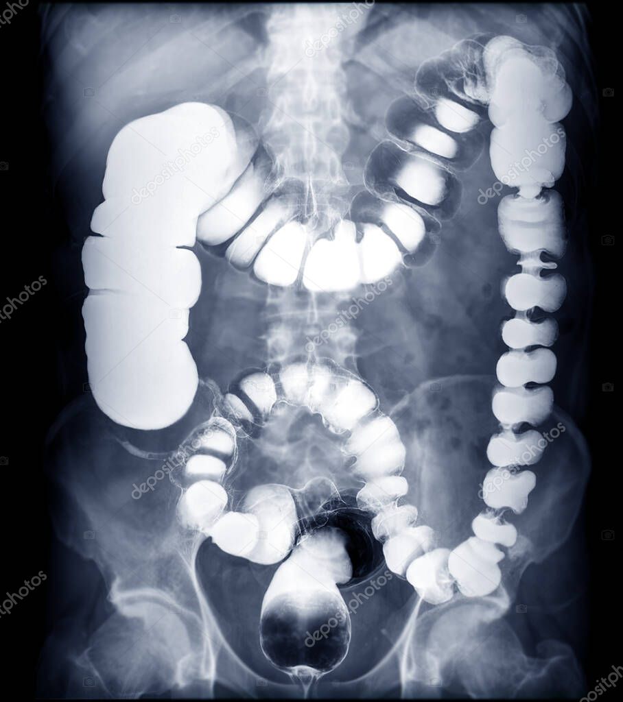 BE or barium enema image or x-ray image of large intestine showing anatomical of colon for detect Colon cancer . 