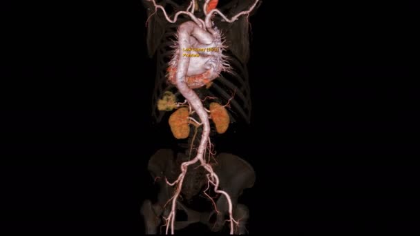 Cta Hele Aorta Weergave Beeld Met Transparant Bot Draai Rond — Stockvideo