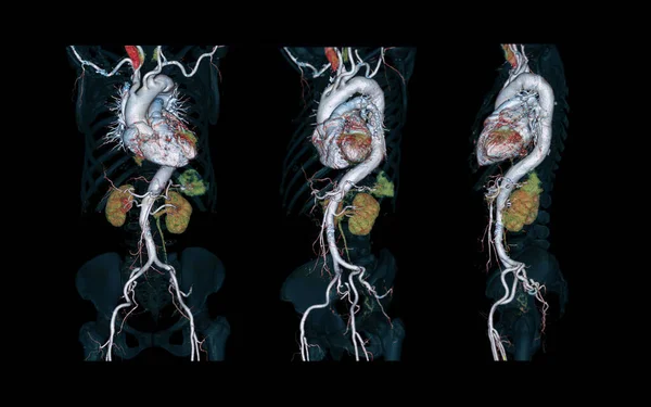 Cta Celá Aorta Vykreslování Obraz Černém Pozadí Pro Detekci Aortální — Stock fotografie