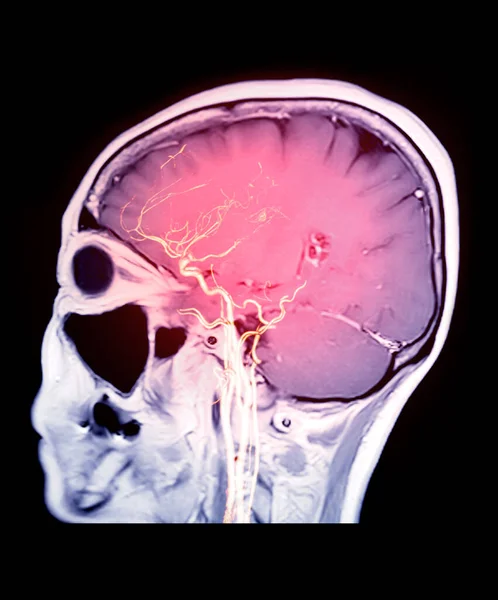 Cerebral Plano Sagital Con Renderizado Cta Cerebro —  Fotos de Stock