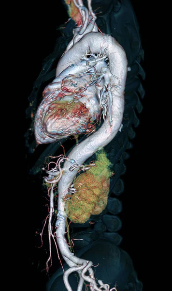 Cta Vue Latérale Image Rendu Aorte Entière Sur Fond Noir — Photo