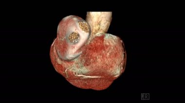 CTA koroner arter 3D görüntüleme görüntüsü, damar koroner arter stenozu teşhisi için ekranı çevirin. .