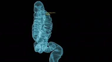 Kolorektal kanseri taramak için anatomik bağırsak görüntüsü gösteren Kolon 3 boyutlu tomografisi veya CT taraması. Kolon Kanserini Kontrol Et.
