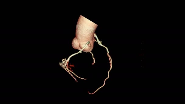 Cta冠動脈3Dレンダリング画像は 血管冠動脈狭窄の診断のために画面上を好転させます — ストック動画