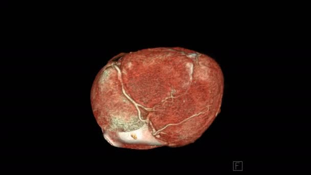 Cta冠動脈3Dレンダリング画像は 血管冠動脈狭窄の診断のために画面上を好転させます — ストック動画